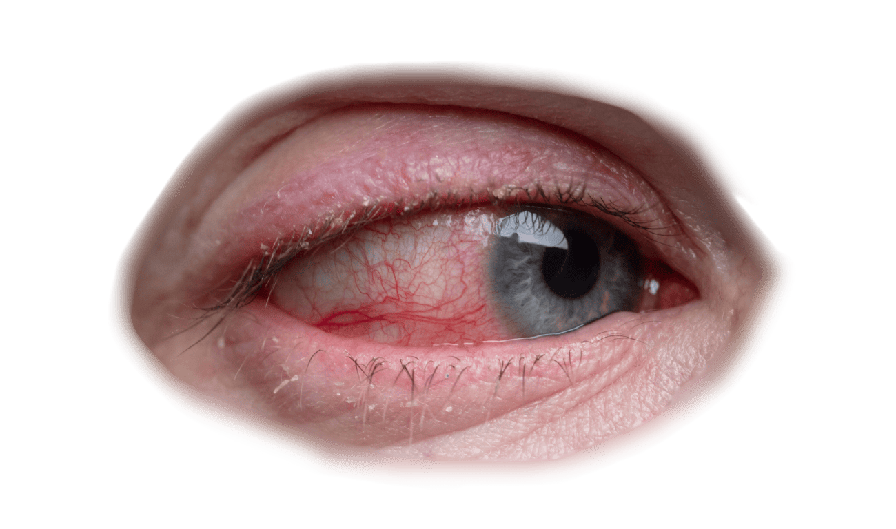 Example of redness and yellow discharge in an eye infection.