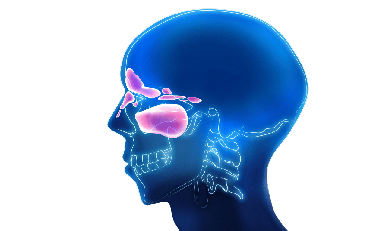 Map of sinuses showing where infection and inflammation takes place