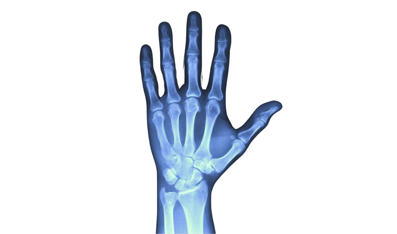 In-House Digital X-Ray Image of hand.